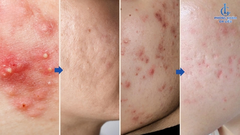 Nặn mụn để lại sẹo rỗ