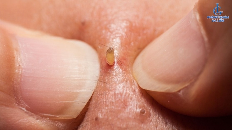 Nặn mụn đã khô cồi