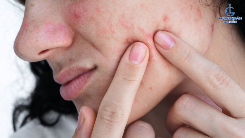 Nặn mụn có bị rỗ không