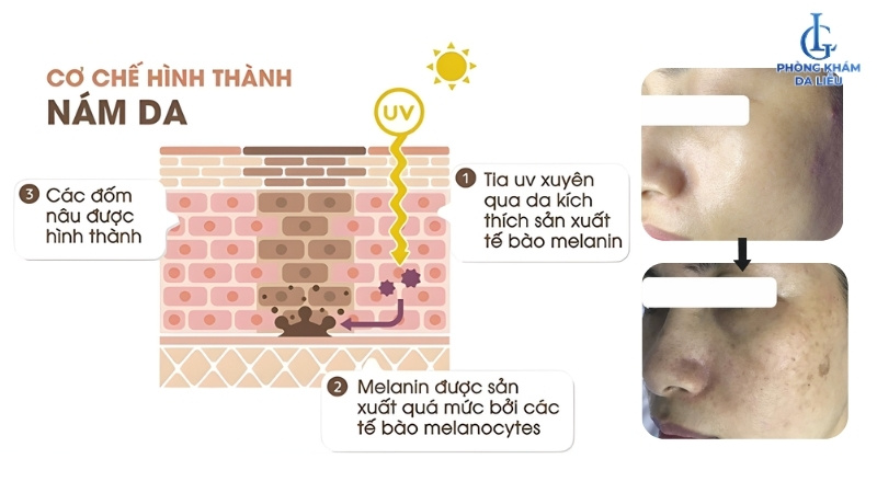 nguyên nhân gây nám da