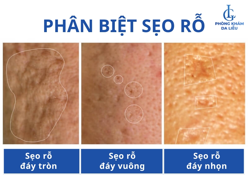 phân biệt sẹo rỗ đáy vuông