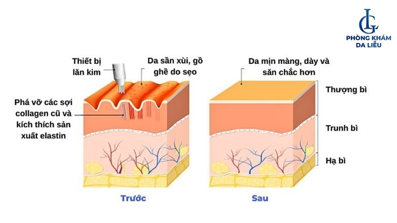 Phi kim trị sẹo rỗ