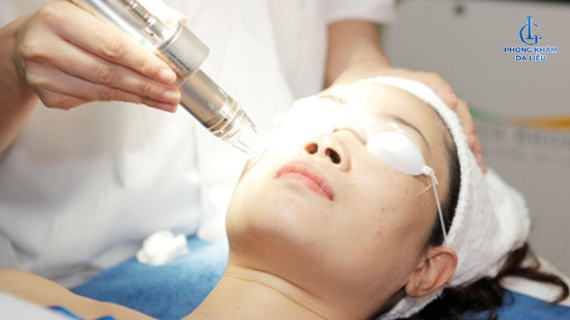 Phi kim trị sẹo rỗ