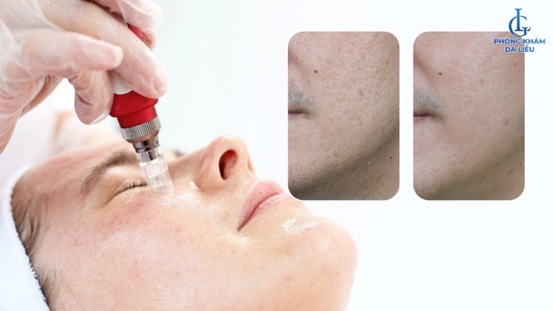 Điều tri sẹo rỗ