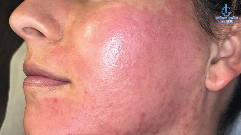 Da đỏ, châm chích sau phi kim