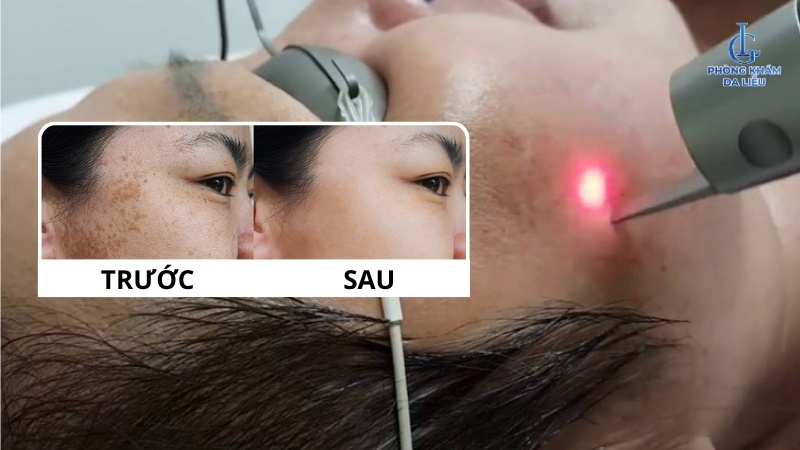 phương pháp điều trị nám chân đinh