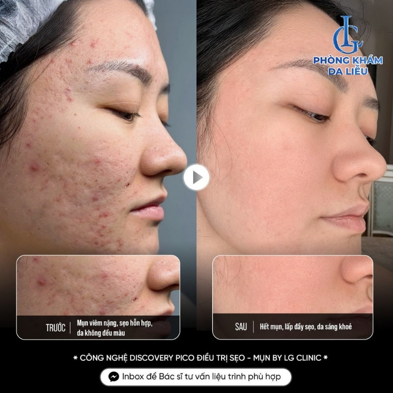 phương pháp điều trị sẹo rỗ đáy nhọn