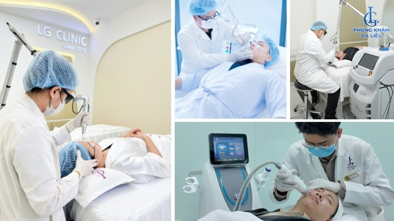 Laser trị sẹo rỗ đáy nhọn