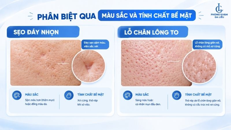 sẹo đáy nhọn và lỗ chân lông to