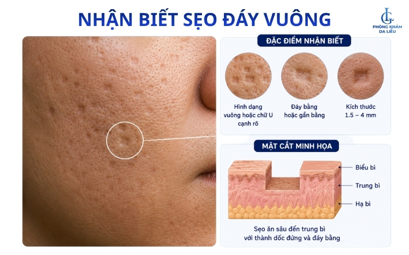 Sẹo đáy vuông