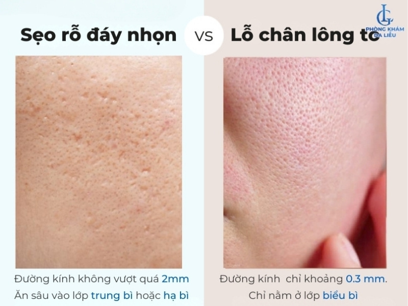 sẹo rỗ đáy nhọn và lỗ chân lông