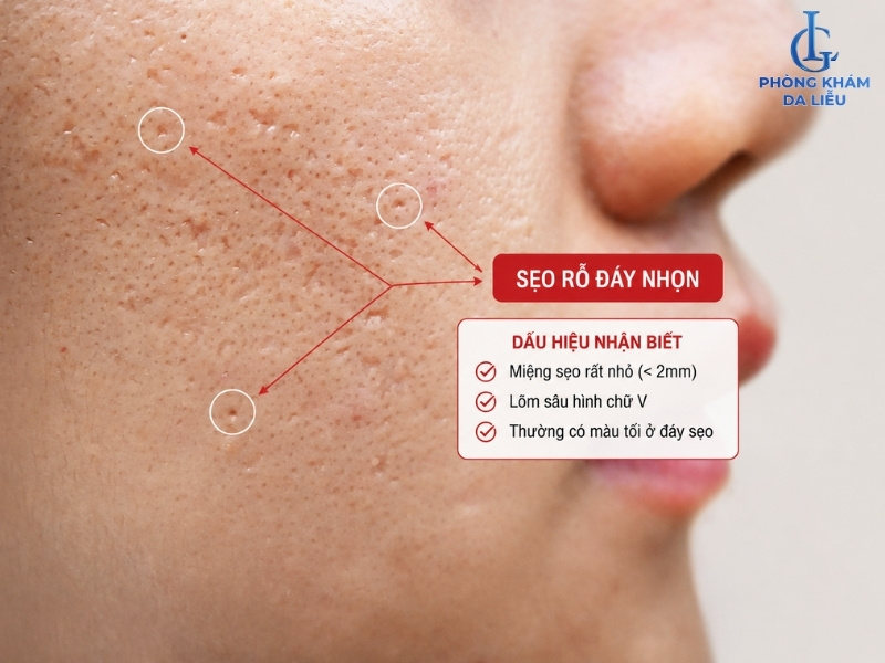 sẹo rỗ đáy nhọn