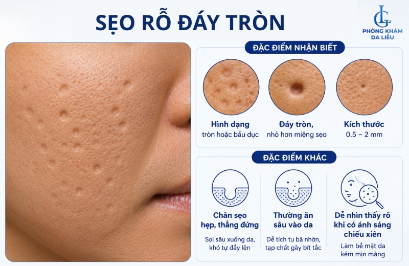 Dấu hiệu nhận biết sẹo rỗ đáy tròn