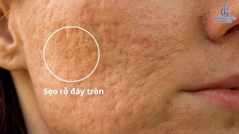 sẹo rỗ đáy tròn