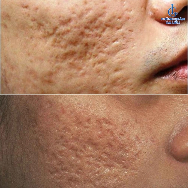 sẹo rỗ đáy vuông