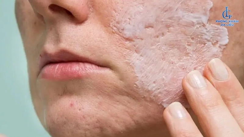 Bôi thuốc trị sẹo lượn sóng