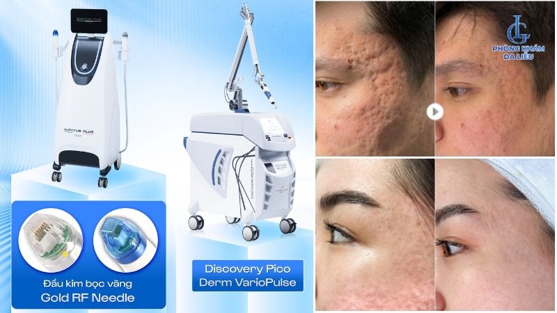 Địa chỉ trị sẹo rỗ uy tín