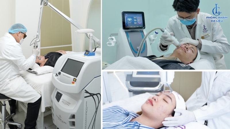 Trị sẹo rỗ lượn sóng công nghệ cao