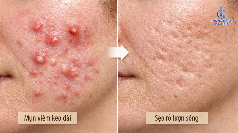 Mụn viêm có thể gây sẹo lượn sóng