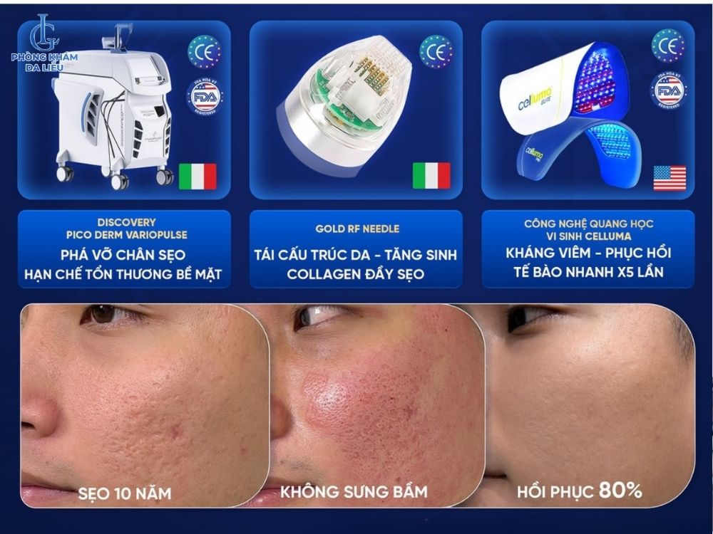 Điều trị sẹo rỗ lượn sóng