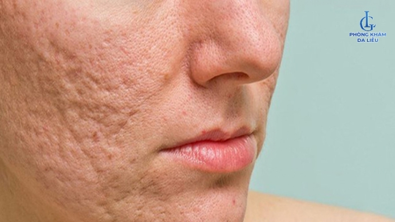 Sẹo rỗ lượn sóng