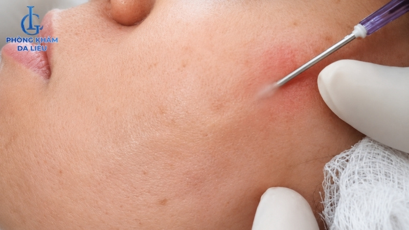 tách đáy sẹo trị sẹo rỗ đáy vuông