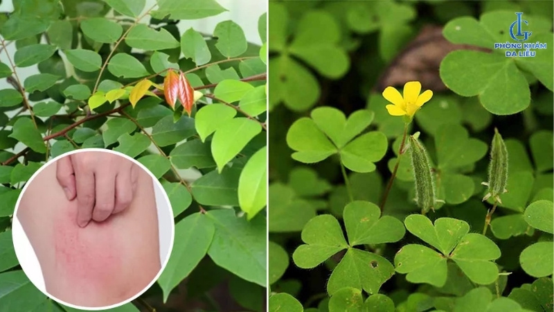 tắm lá khế me chua trị viêm nang lông