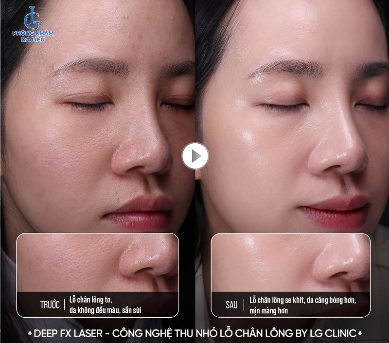 Thu nhỏ lỗ chân lông bằng công nghệ Deep FX Laser