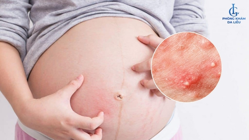 tình trạng bà bầu bị viêm lỗ chân lông