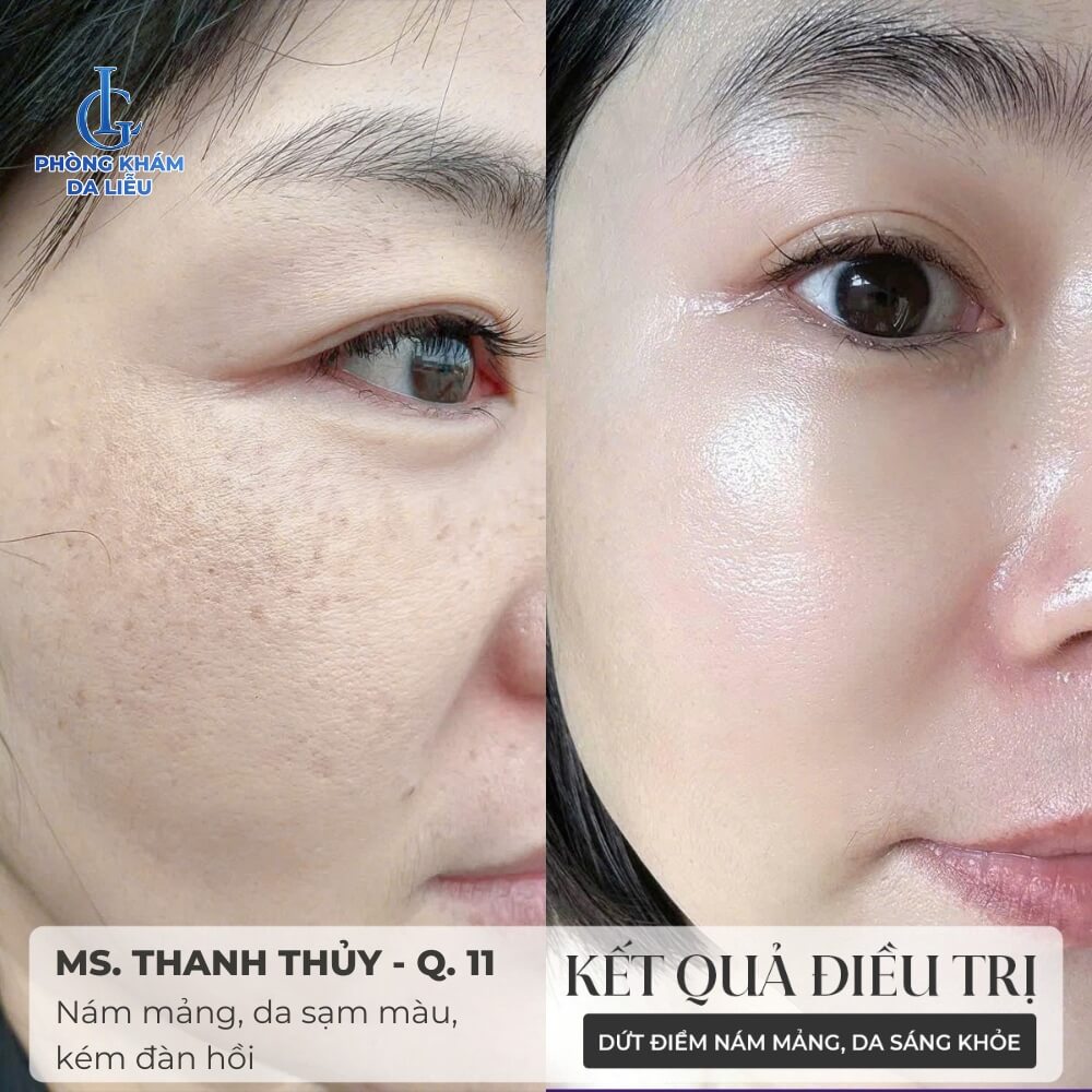 điều trị nám cánh bướm