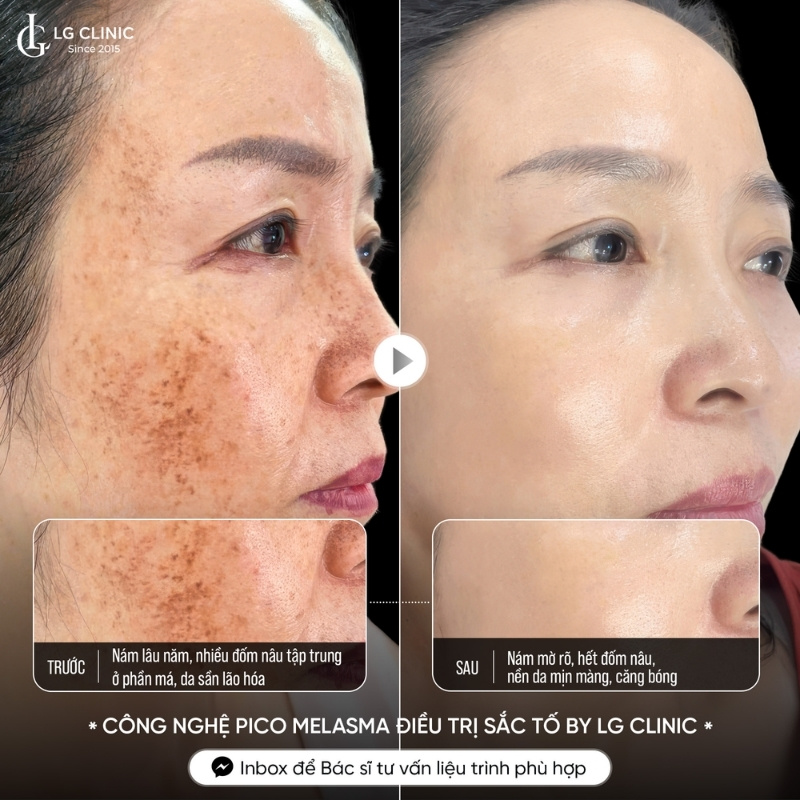 trị nám da mặt triệt để