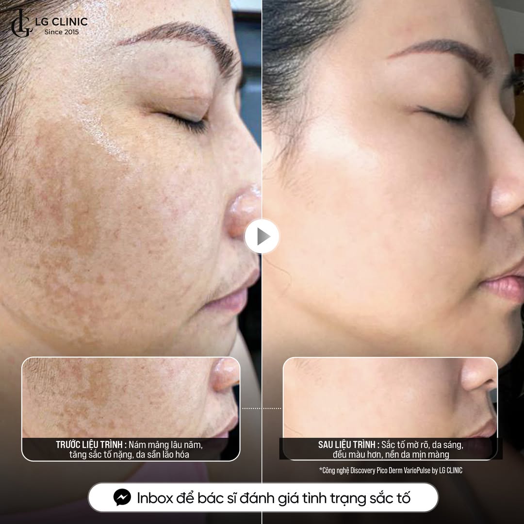 Điều trị nám da mặt vùng má