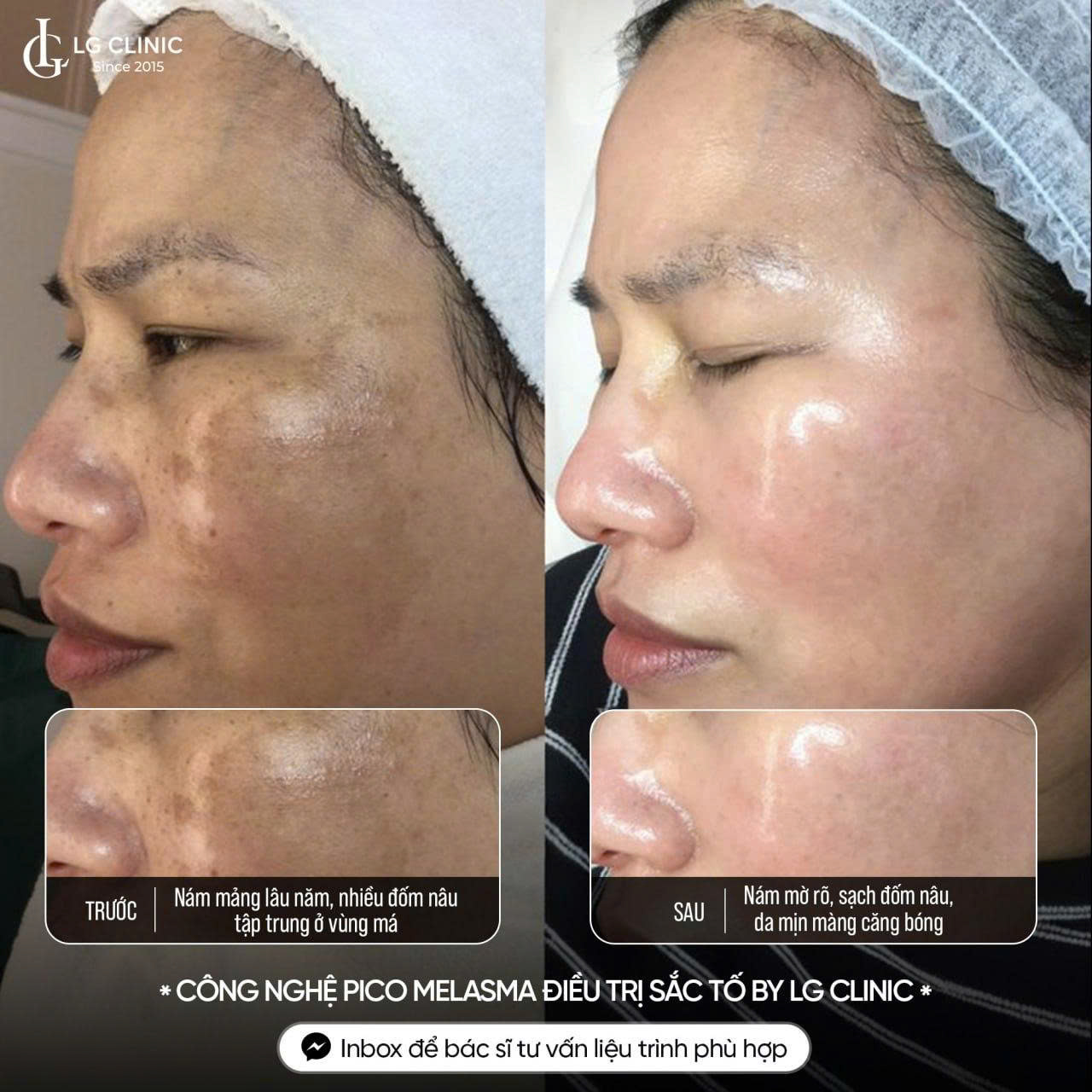 Điều trị nám da mặt vùng má uy tín