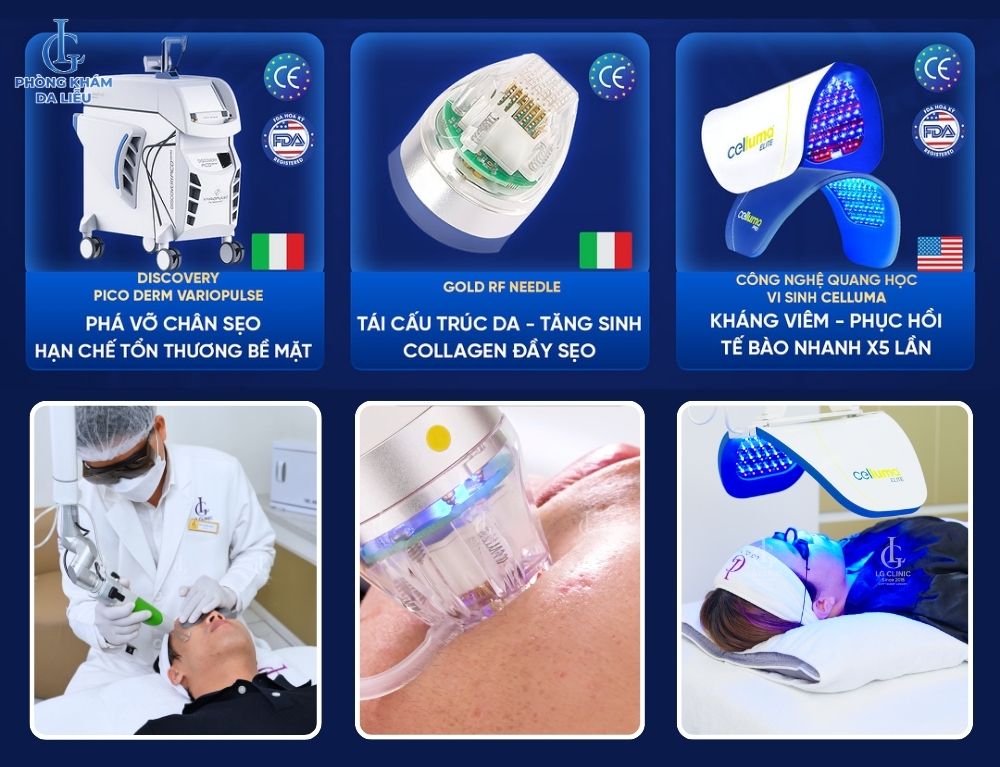 Phác đồ trị sẹo rỗ triple treatment