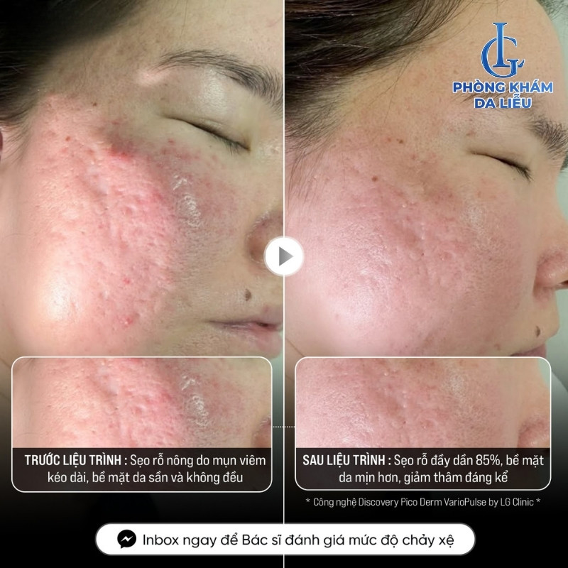 trị sẹo rỗ đáy nhọn