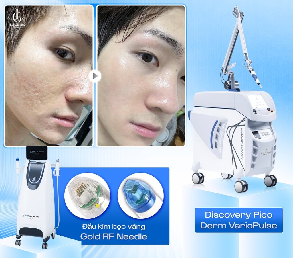 trị sẹo rỗ đáy tròn