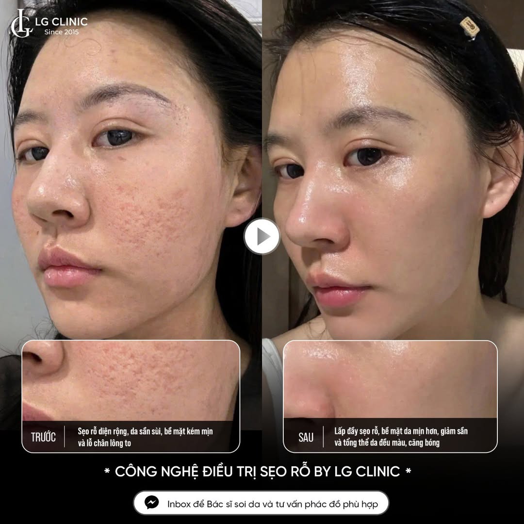 trị sẹo rỗ đáy vuông