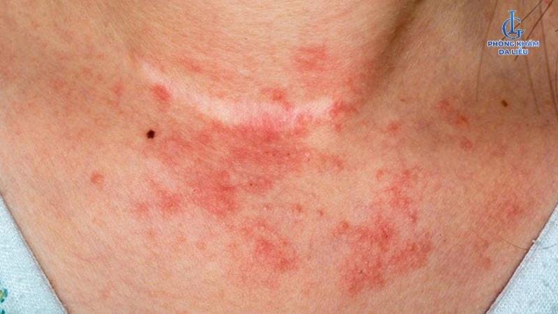 trị viêm nang lông bằng aspirin