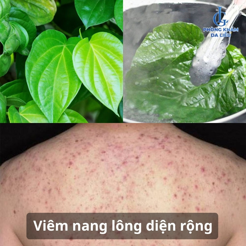 trị viêm nang lông bằng lá trầu không