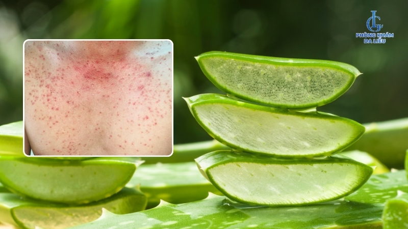 trị viêm nang lông bằng nha đam tại nhà