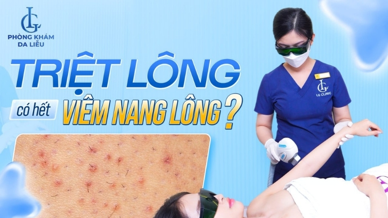 triệt lông có hết viêm nang lông