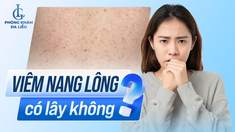 viêm nang lông có lây không
