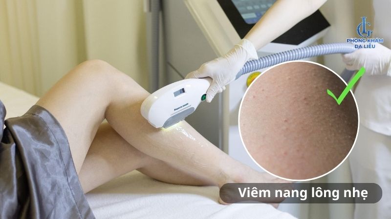 viêm nang lông có nên triệt lông không
