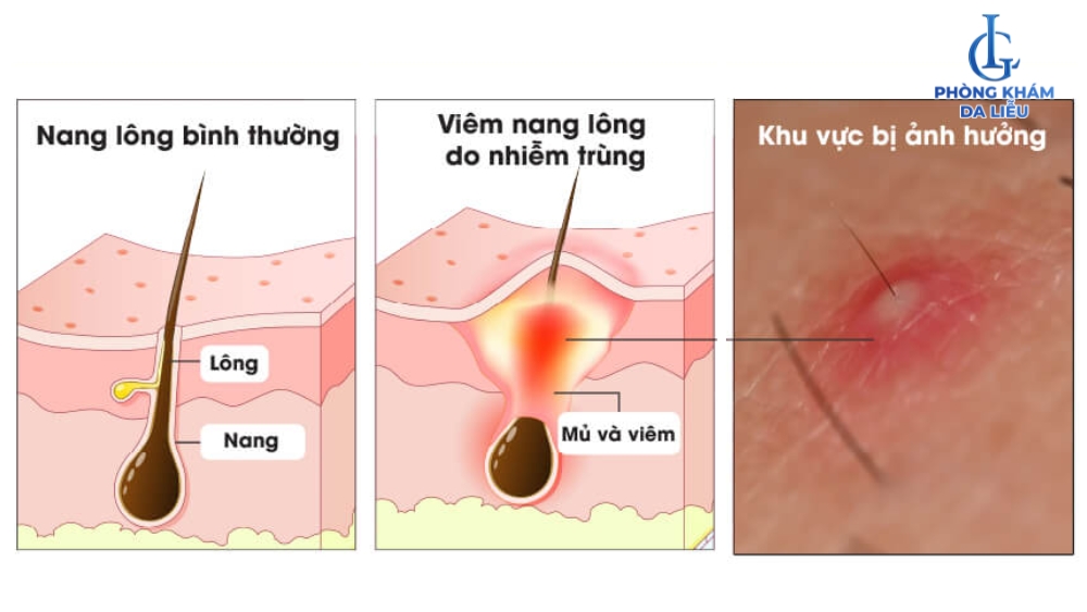 viêm nang lông hậu môn