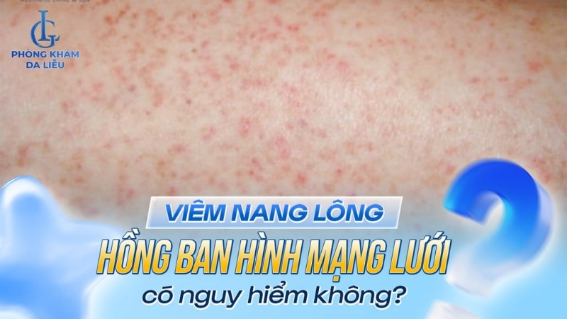 viêm nang lông hồng ban hình mạng lưới