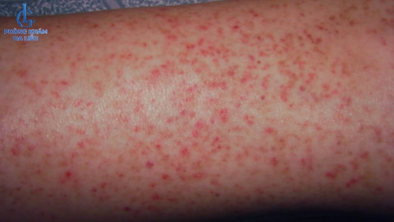 viêm nang lông hồng ban hình mạng lưới