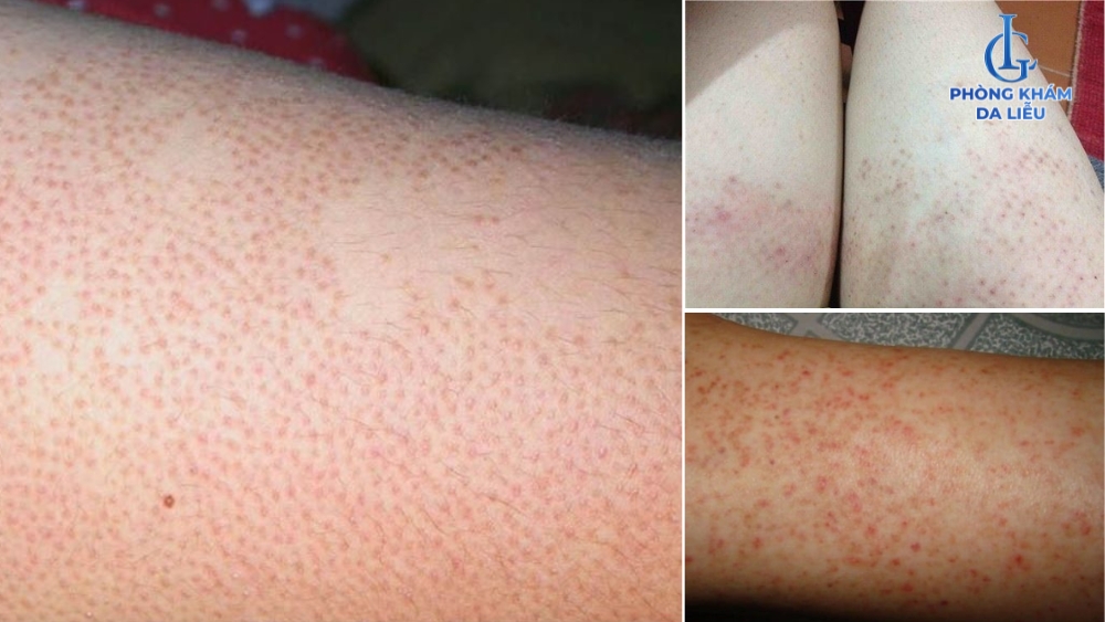 viêm nang lông hồng ban hình mạng lưới