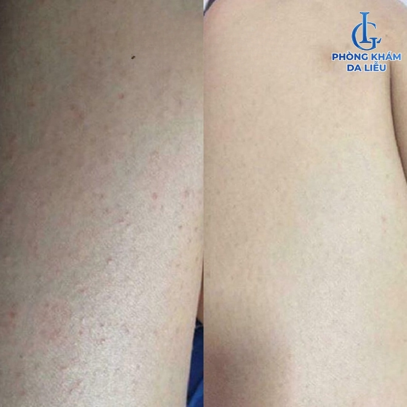 viêm nang lông nên tắm lá gì