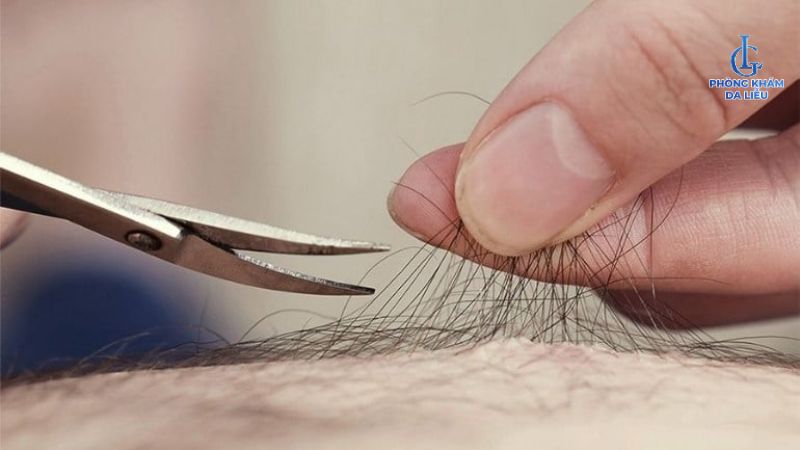viêm nang lông nên triệt lông không