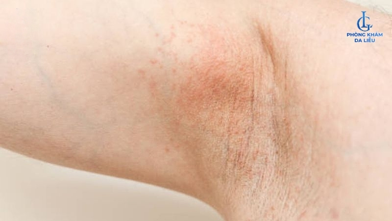 viêm nang lông sau khi wax lông